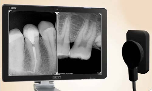 Digital RVG (Intraoral X-Ray)
