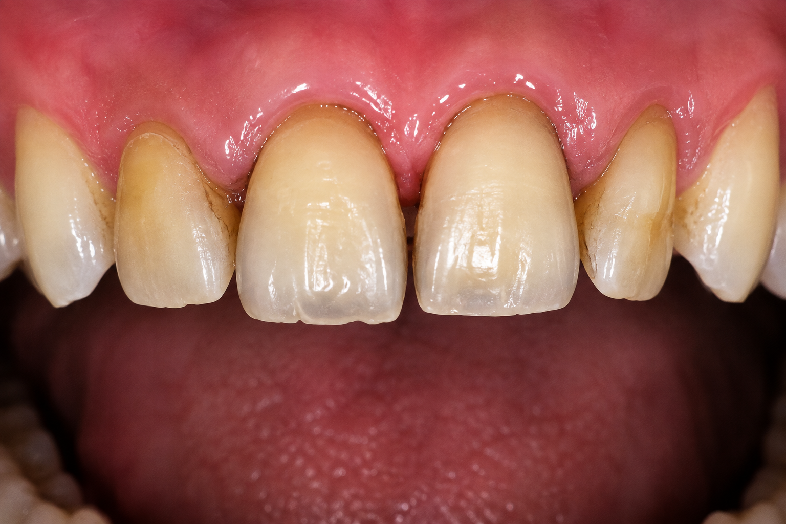 Before treatment