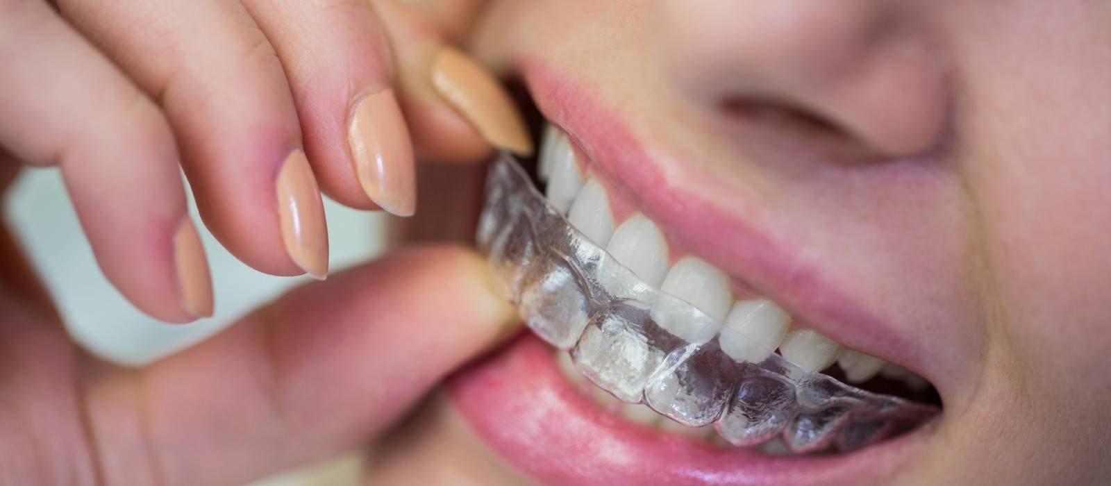 Orthodontics & Clear Aligners