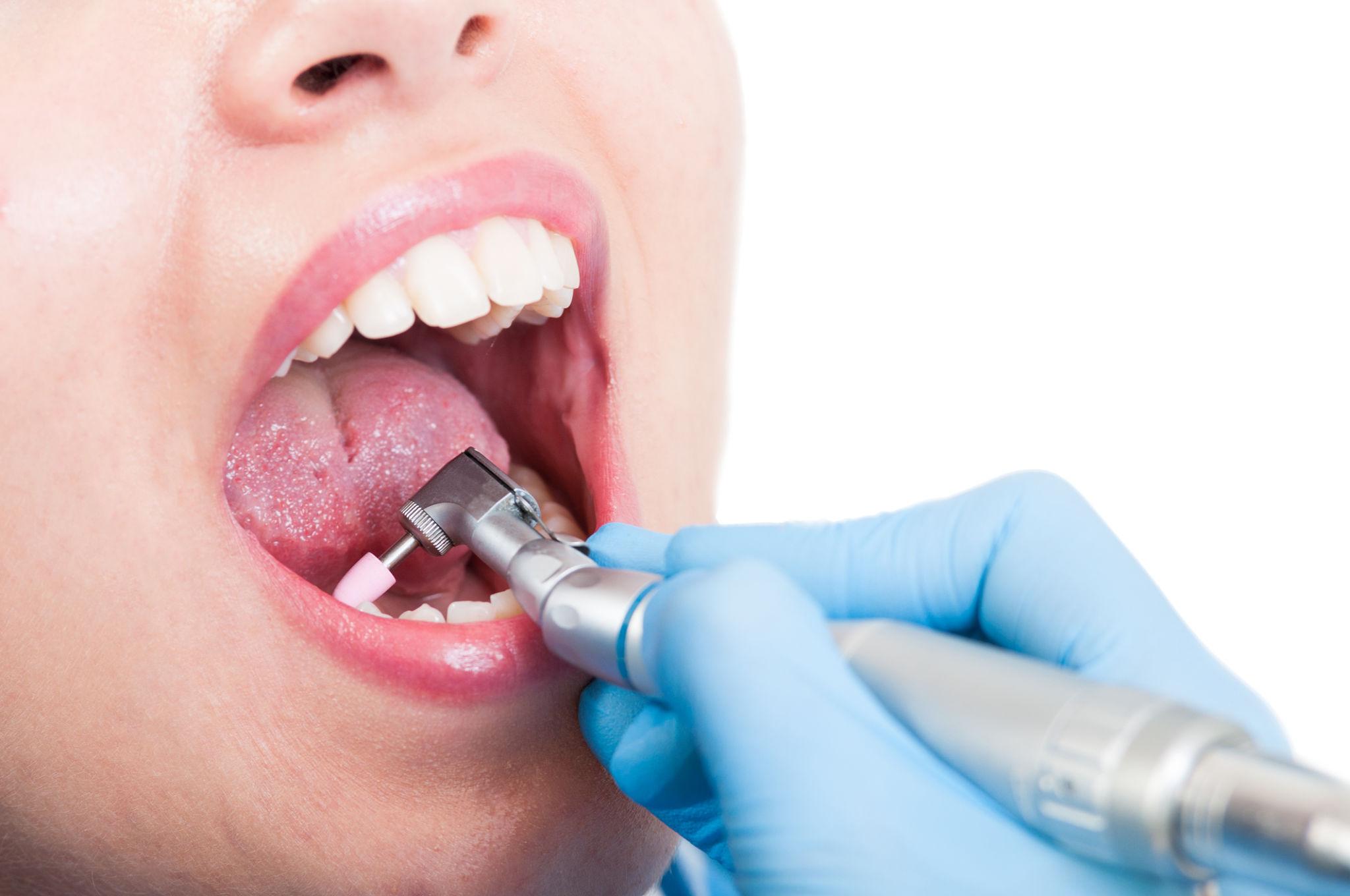 Teeth Cleaning and Polishing